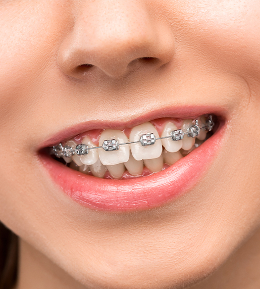 Jaw Surgery