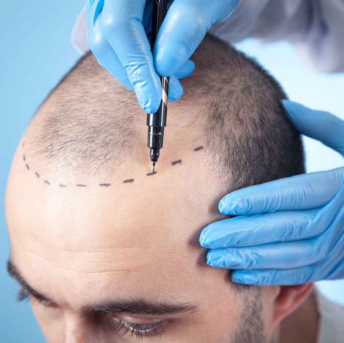 Hair Transplant