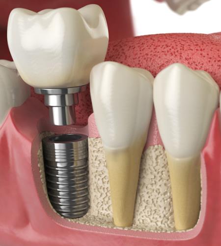 Implant Treatments