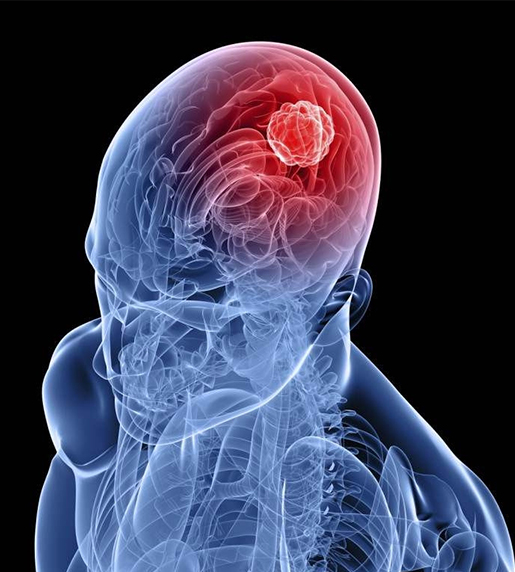 Tumor Surgery