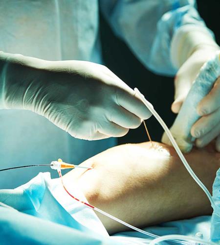 Varicose Surgery