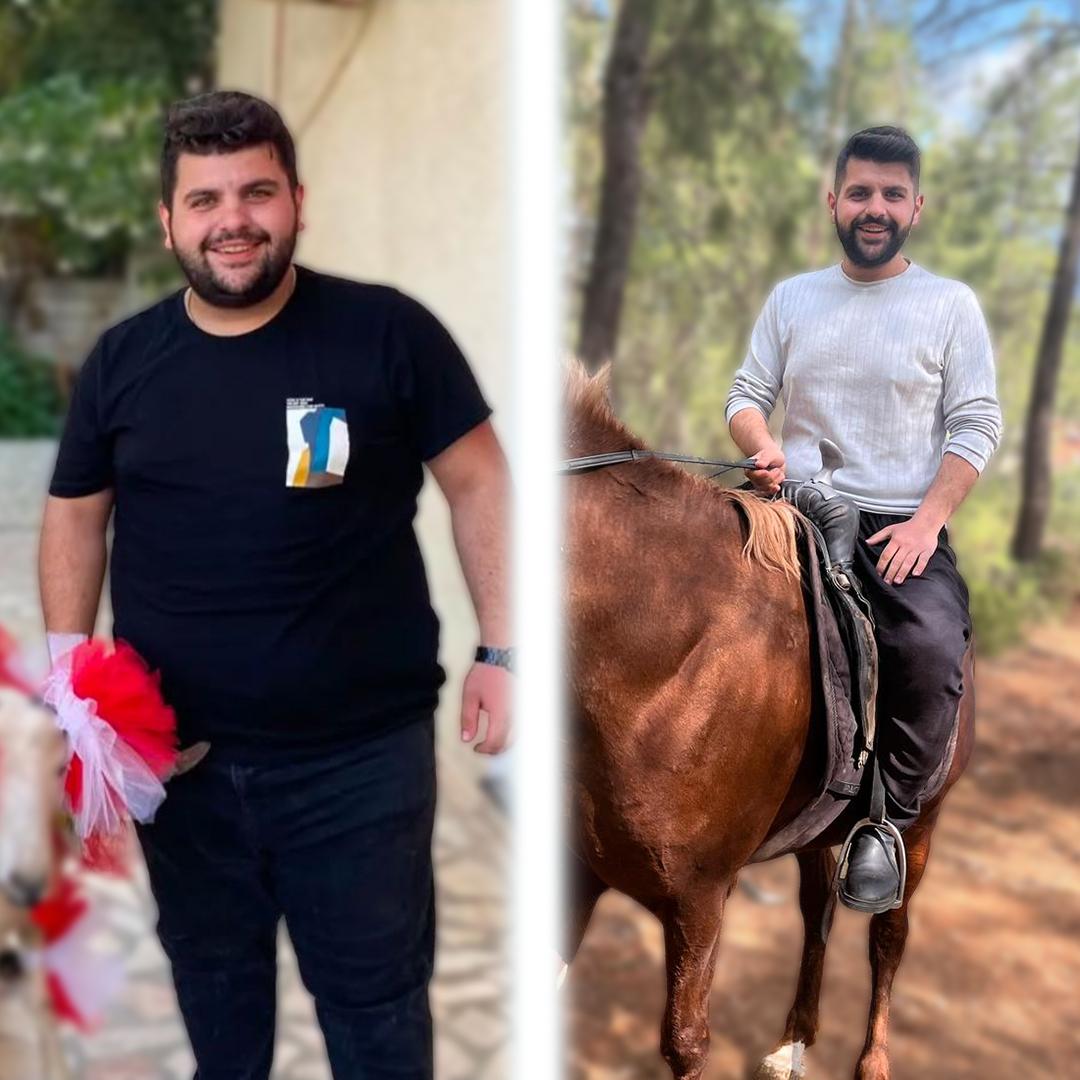 Obesity surgery before after – gastric sleeve