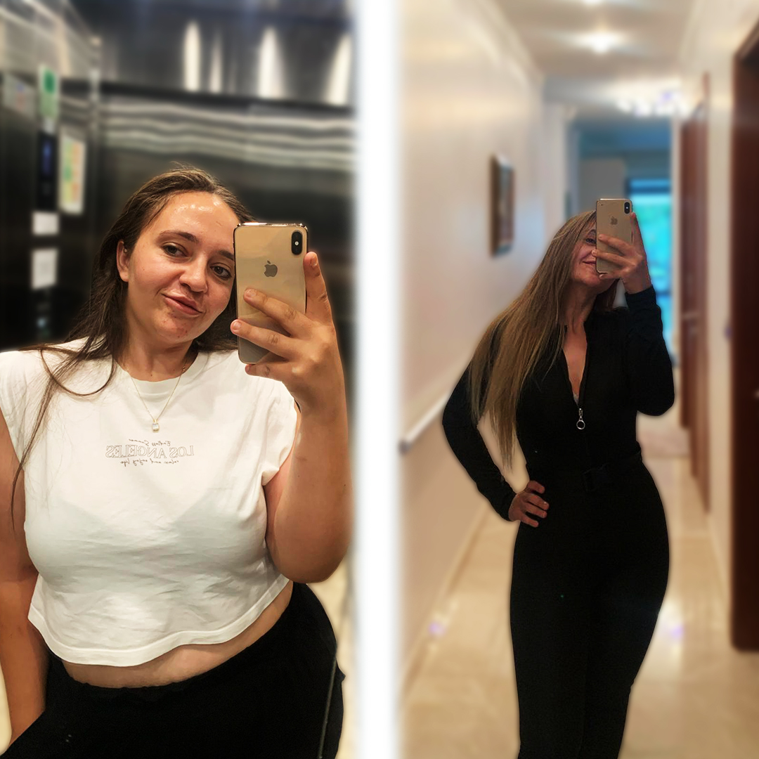 Bariatric transformation – gastric sleeve patient