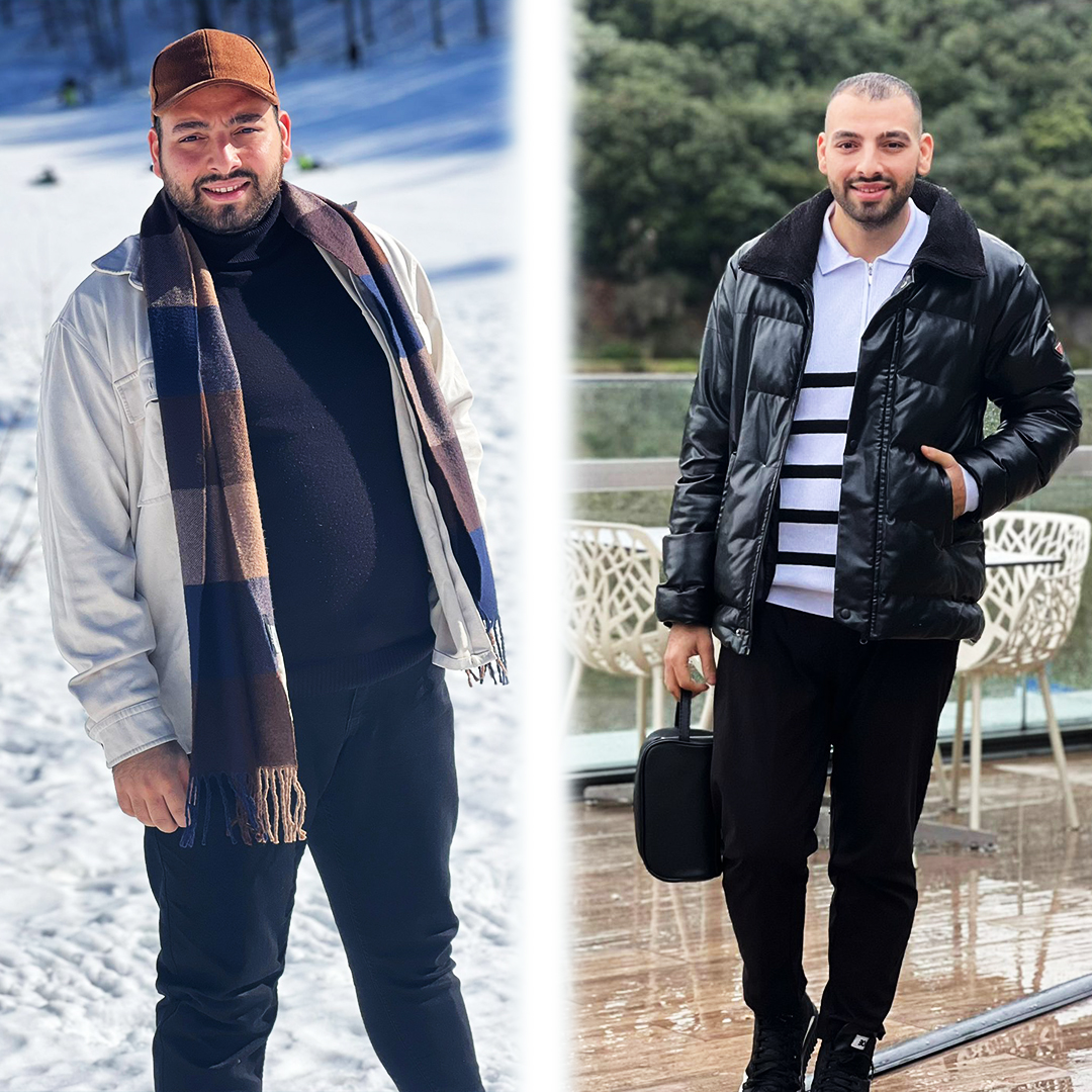 Gastric sleeve photo comparison – real patient