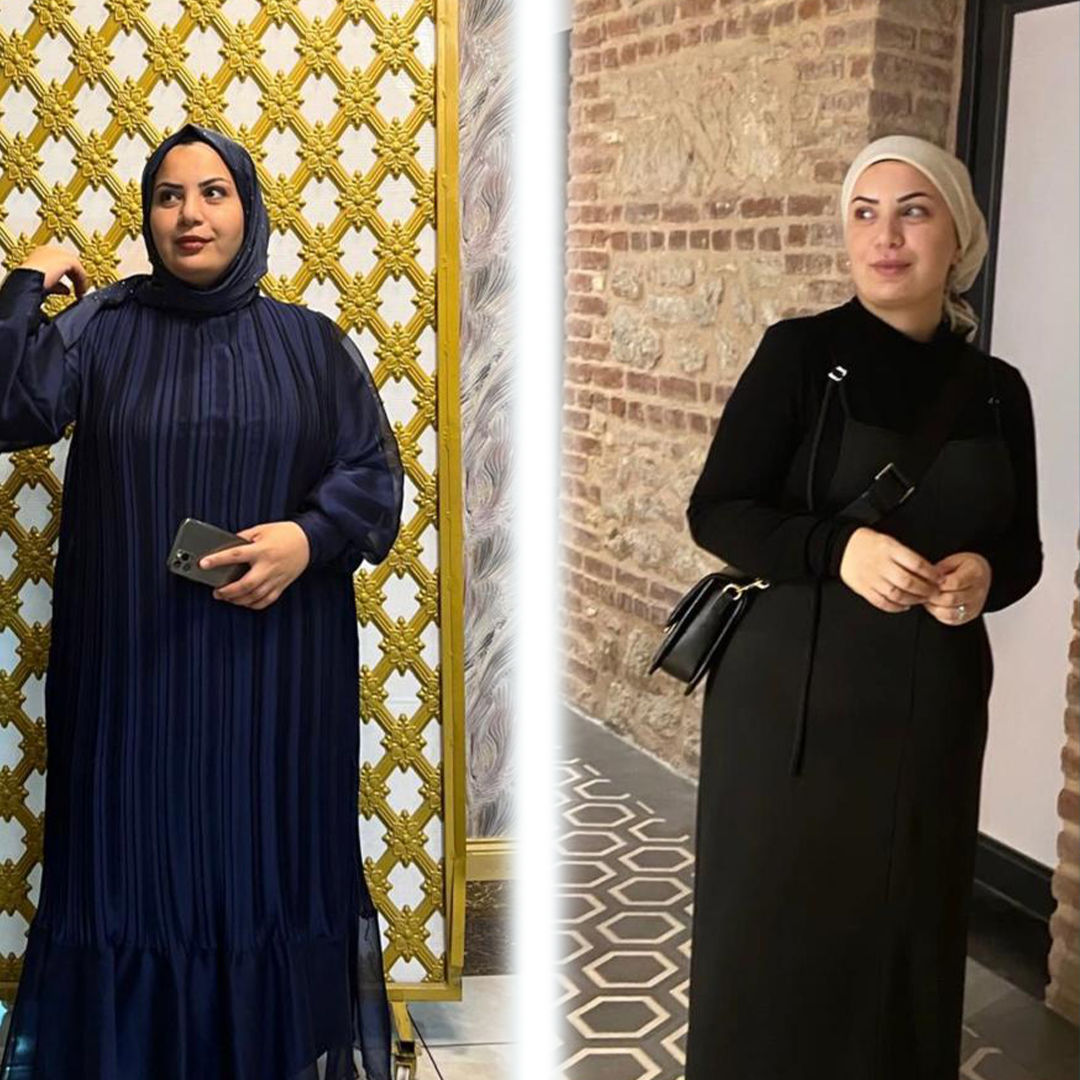 Bariatric surgery results – gastric sleeve transformation