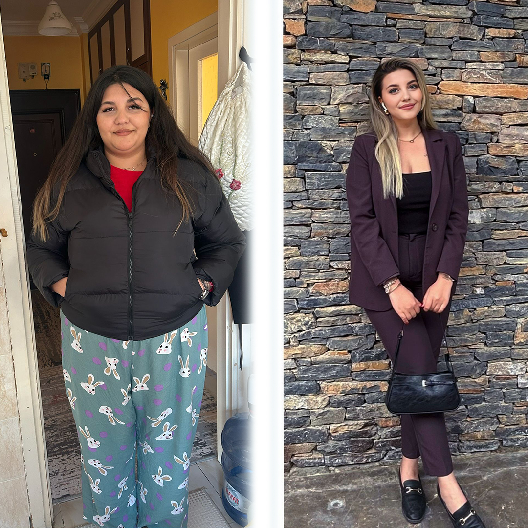 Real results of gastric sleeve procedure