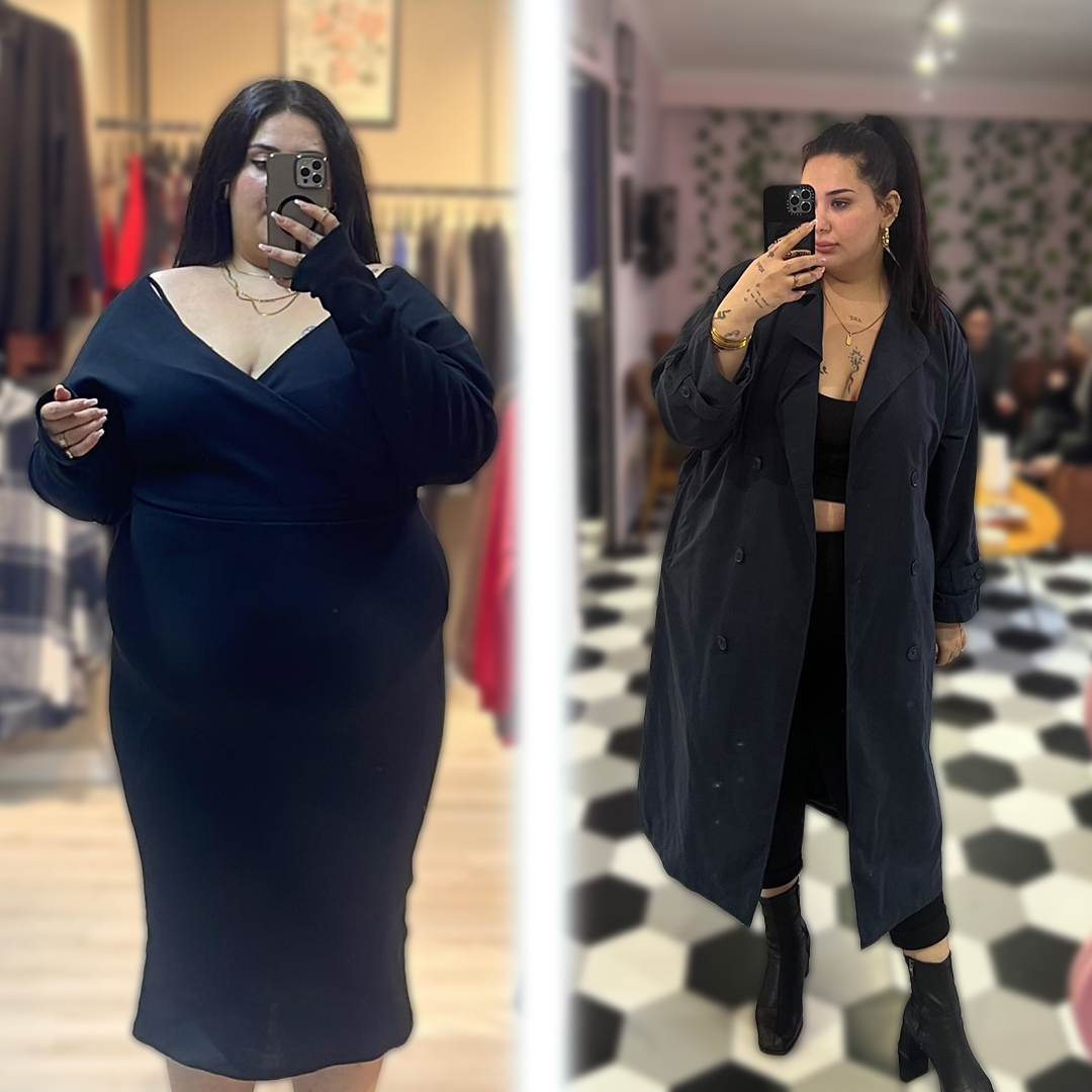 Slimming transformation – gastric sleeve example