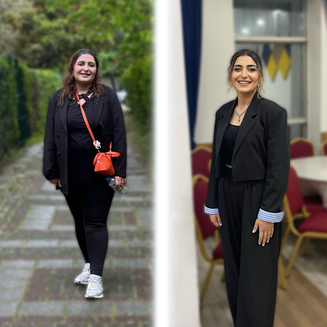Weight loss success with gastric sleeve